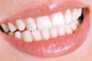 Berpasang Tooth Gem, Apakah Ini Bertahan Lama? Tips Perawatan Gigi yang Viral di Gen Z